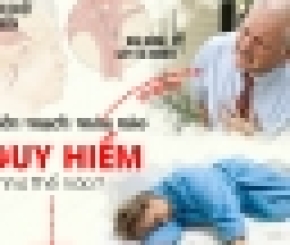 Bộ Y tế hướng dẫn chẩn đoán và xử trí đột quỵ não