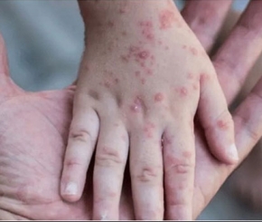 Thông tin về bệnh đậu mùa khỉ