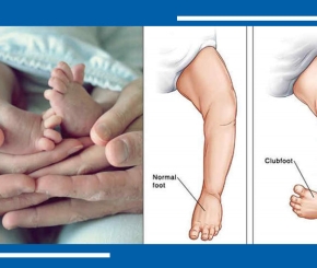 Phân biệt bàn chân khoèo bẩm sinh và bàn chân áp sinh lý ở trẻ sơ sinh
