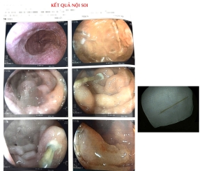 Dị vật xuyên thành tá tràng – Phát hiện và xử trí kịp thời