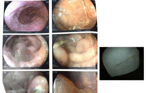 Dị vật xuyên thành tá tràng – Phát hiện và xử trí kịp thời