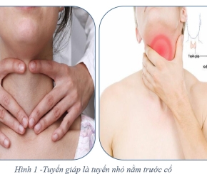 Điều trị Nhân giáp lành tính bằng sóng cao tần