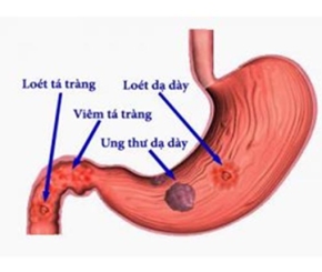 Chăm sóc Người bệnh sau mổ ung thư (K) dạ dày