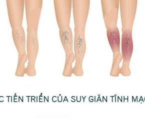 Bệnh Suy giãn tĩnh mạch có nguy hiểm không?