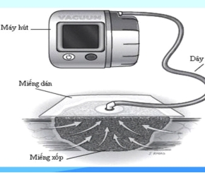 Theo dõi và sử dụng máy hút lực âm trong điều trị vết thương
