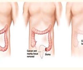 Những điều cần biết về ung thư Trực tràng